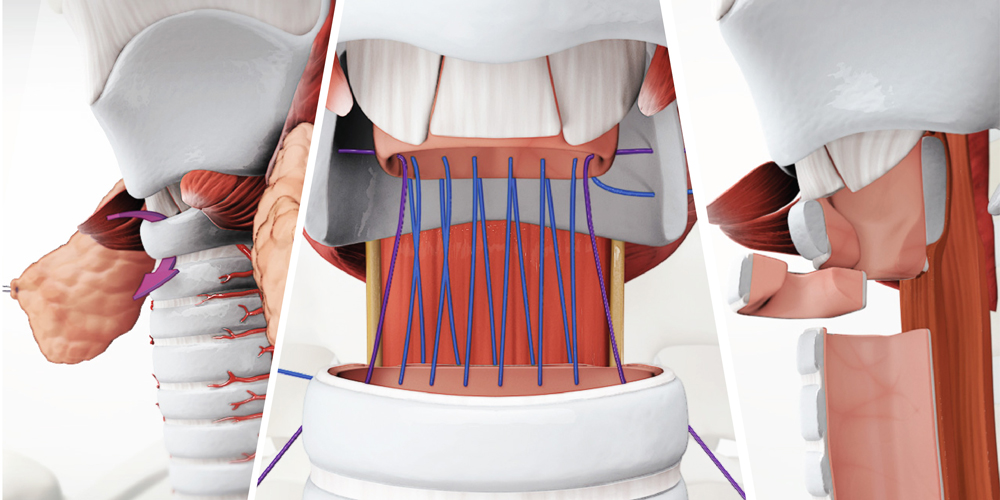 Cricotracheal Resection For Subglottic Tracheal Stenosis Tvasurg