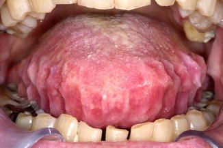 Enlarged Tongue Macroglossia Sometimes With Rippled Edges