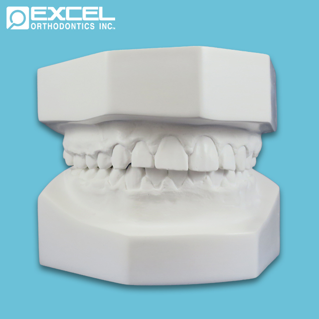 Excel Orthodontics Case Study Nexa3d