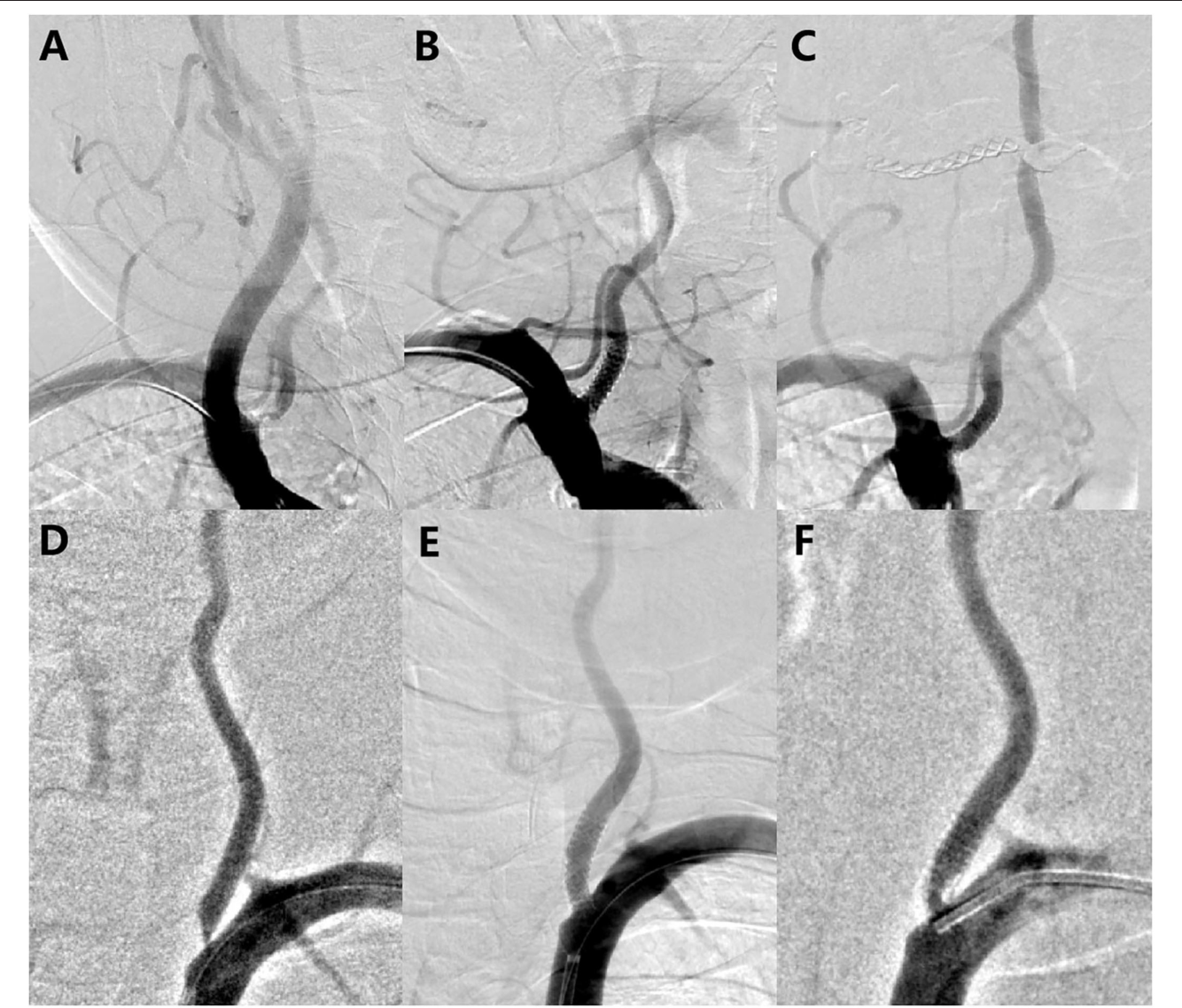 Frontiers Safety And Efficacy Of Rapamycin Eluting Vertebral Stents