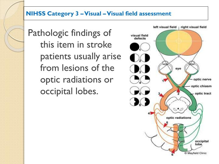 Ppt Nih Stroke Scale Assessment Of The Acute Stroke Patient