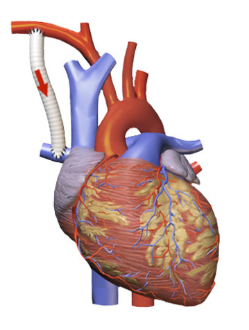 Recanalisation Of Totally Occluded Modified Blalock Taussig Shunt